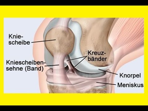 Osteochondrose der Halswirbelsäule zum Schlaganfall führen können Wie man gewinnt Osteochondrose