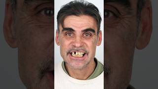 Full Smile Reconstruction with Zirconia Crowns