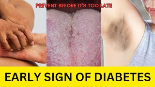 9 Warning Signs That You May Have Diabetes | Diabetes Symptom