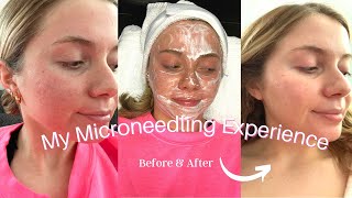MICRONEEDLING VLOG: Before & After, Is it worth it, Microneedling for acne scars, Results