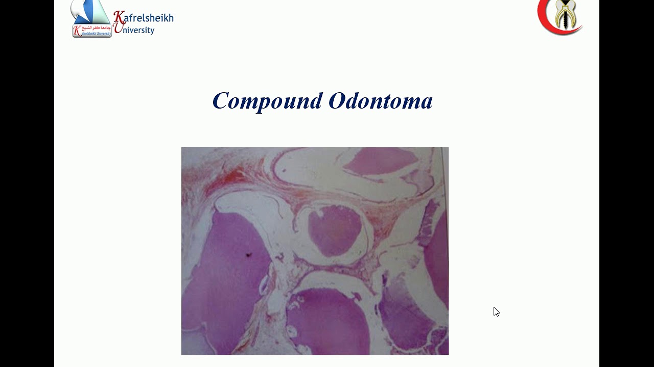 cementoblastoma and mixed odontogenic - YouTube