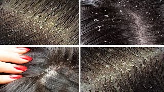 How to Remove Dandruff from Hair at Home Permanently