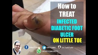 How to TREAT INFECTED DIABETIC FOOT ULCER | LIVE from our clinic