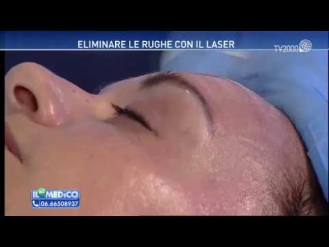 La migliore faccia fa i bagagli da posti Eliminazione laser di orli su una faccia dopo posti