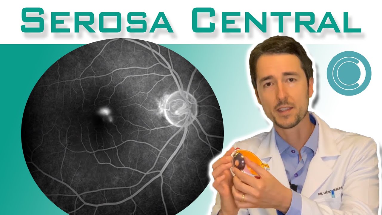 Serosa Central - Tratamento | Canal Retina e Vítreo