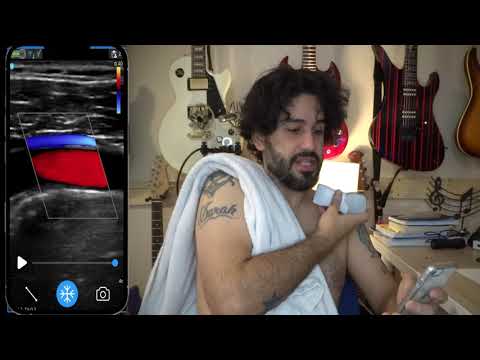 Vscan Upper Extremity Venous Demo