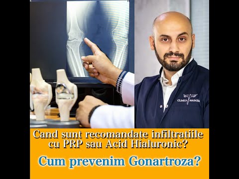 Tratament pentru artroza la genunchi