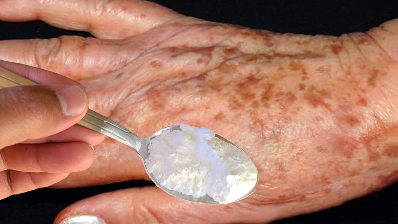 MORRIA E NÃO SABIA: É só esfregar MAIZENA nas PINTAS PRETAS e não precisa mais gastar na farmácia