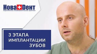 Имплантация зубов этапы. 📋 Подробная консультация стоматолога о каждом этапе имплантации зубов. 12+