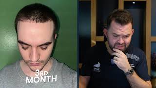 Case Study: 2150 Grafts | 12-Month Result | Dr. Mehmet Erdoğan, Smile Hair Clinic