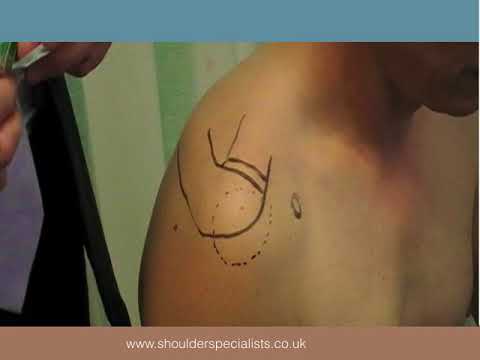 Shoulder Injections in General and Physiotherapy Practice