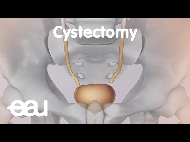 Understanding Cystectomy: A Comprehensive Guide to Bladder Cancer ...