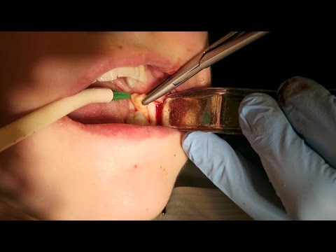 Surgical Extraction Of Wisdom Tooth