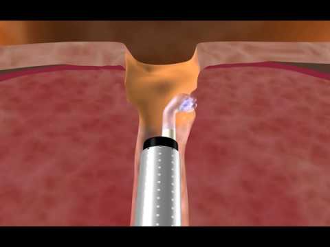 Zabieg waporyzacji prostaty laserem diodowym Leonardo z światłowodem TWISTER -  animacja