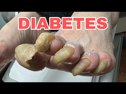 VERY THICK AND LONG DIABETIC TOE NAILS