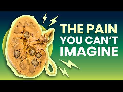 Kidney Stones: The Most PAINFUL Condition on Earth?