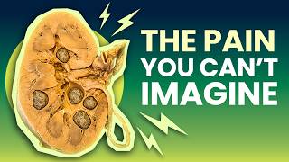 Kidney Stones: The Most PAINFUL Condition on Earth?