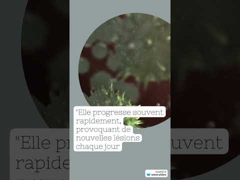 Vidéo impétigo - Dr Rousseau
