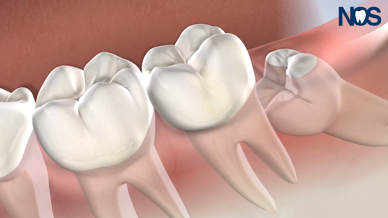 Wisdom Teeth Removal at Naperville Oral Surgery & Dental Implants