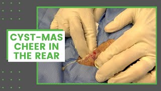 Cyst-Mas Cheer in the Rear | Dr. Derm