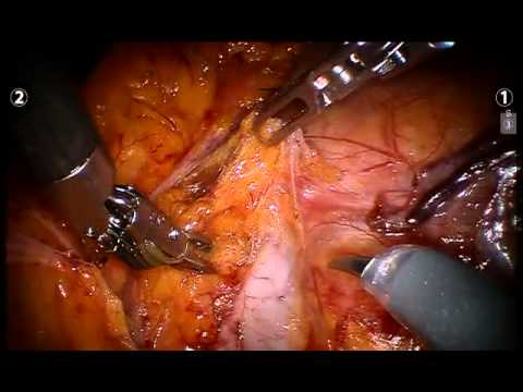 Clamp Free Partial Nephrectomy