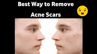Best Way to Remove Acne Scars 😍