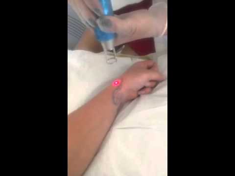 Tattoo removal
