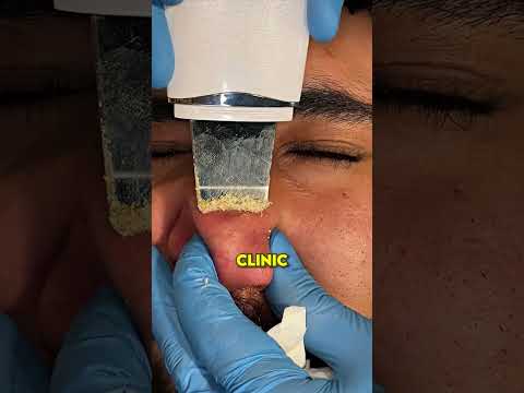 Man Cleans His Nose For the First TIme in 15 YEARS! 🤯