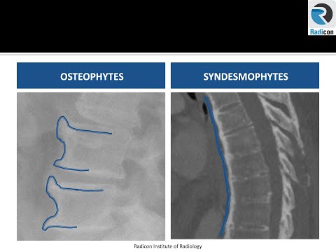 Lumbar Spine MRI Part 6: Phytes and Modic Changes