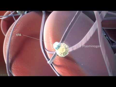 How tPA is Used to Treat Ischemic Stroke