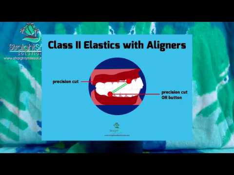 Class II 2,  III 3 elastics clear aligners https://www.straightsmilesolutions.com/