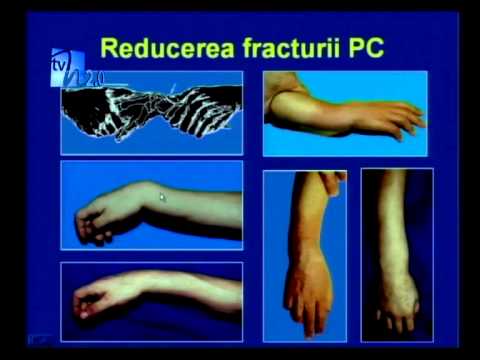 Articulații de artrită frecventă