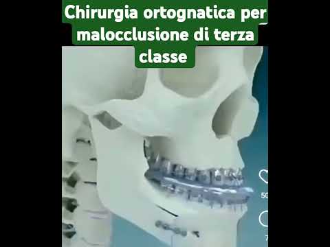 chirurgia ortognatica per malocclusione di terza classe