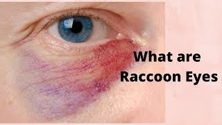 What are Raccoon Eyes