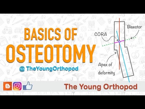 Basics of Osteotomy