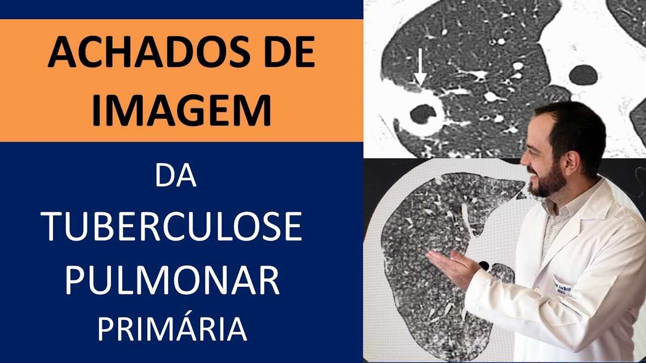 ACHADOS DE IMAGEM - RADIOGRAFIA E TOMOGRAFIA- DA TUBERCULOSE PULMONAR PRIMÁRIA- TEORIA E CASOS