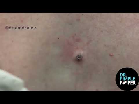 8 MINUTES OF SATISFYING POPS with Dr Sandra Lee / Dr Pimple Popper