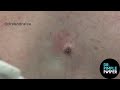 8 MINUTES OF SATISFYING POPS with Dr Sandra Lee / Dr Pimple Popper