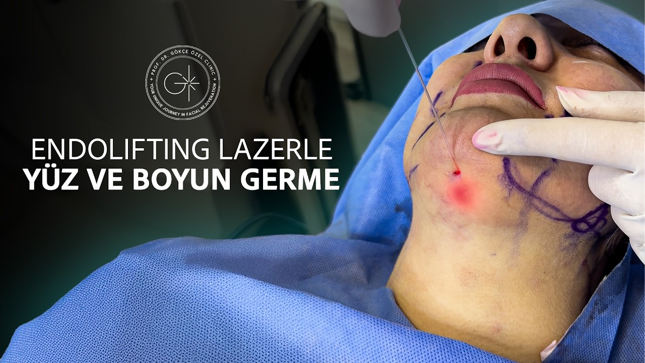 ENDOLIFT İLE ÇENE ALTI VE ÇİZGİSİ GERME: AMELİYATSIZ YÜZ GENÇLEŞTİRME
