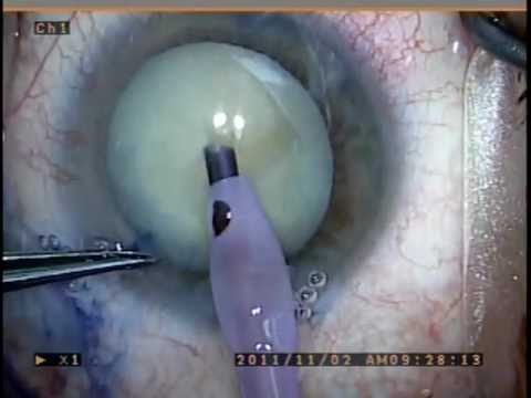 Ophtalmology • Ophtalmology •