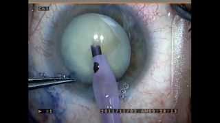 &quot;Great White&quot; Cataract Surgery