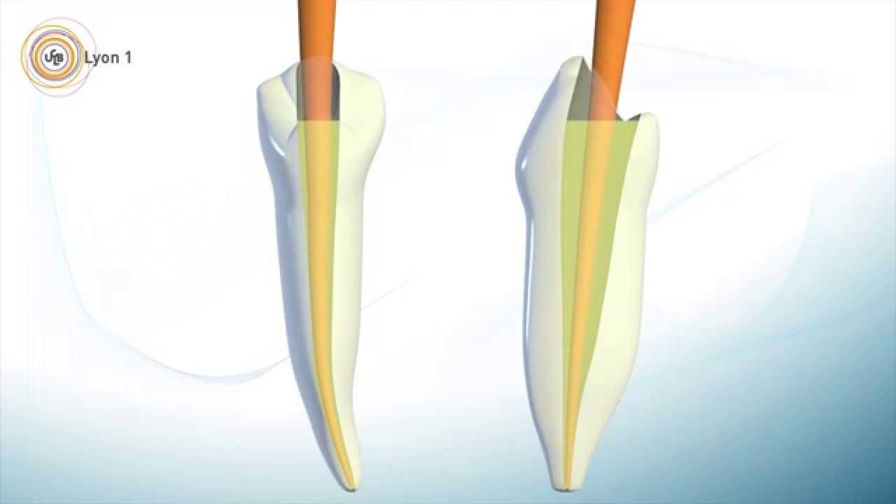 Obturation endodontique : la technique de condensation latérale à froid