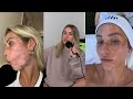 Alix vs. Acne | Hot Mess with Alix Earle