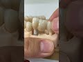 Between cement and screw retained implants!