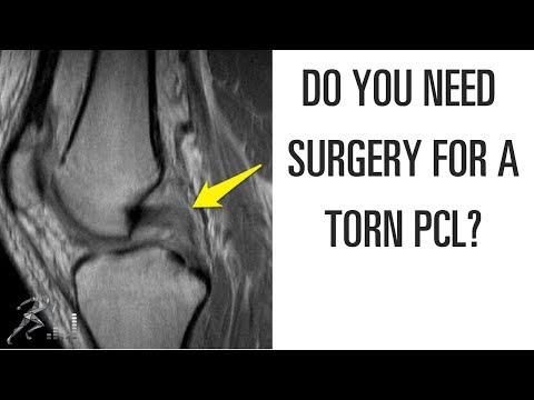 Do you need surgery for a torn PCL?