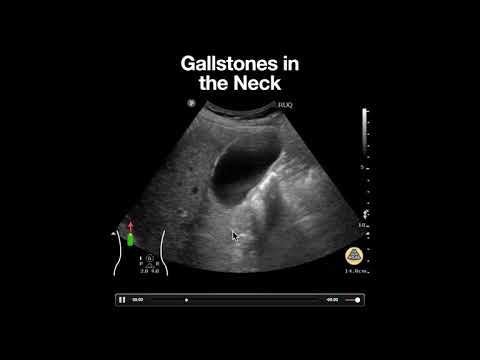 Gallstones in the Neck of the Gallbladder