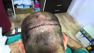 preview picture of video 'Hair Transplant in Bangalore at New You Hair Clinic Dr. Kishore Babu Pentyala'