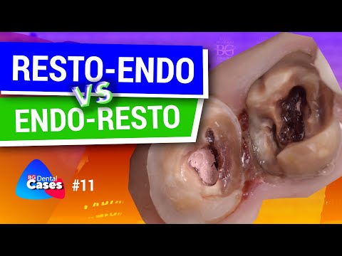Resto-Endo VS Endo-Resto