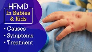 Hand, Foot and Mouth Disease (HFMD) in Babies