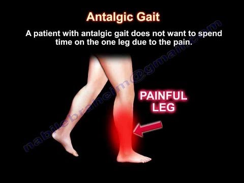image-What does Antalgic mean?